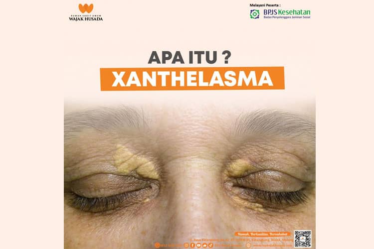 Mengenal Xanthelasma, Pengendapan Kolesterol di Kelopak Mata