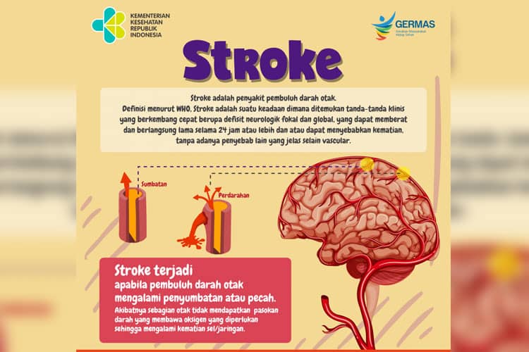 Apa Itu Penyakit Stroke? Kenali Sejak Dini