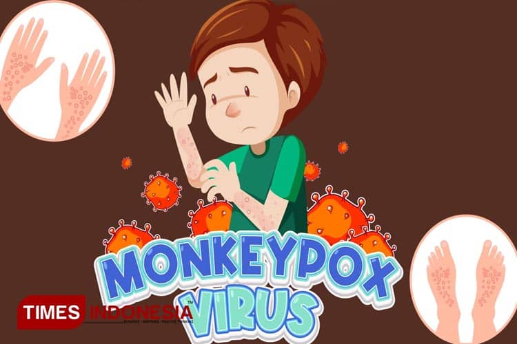 Waspada Monkeypox, Dinkes Banyuwangi: Gonta Ganti Pasangan Beresiko Tinggi Penularan