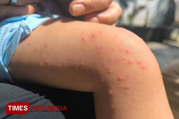 Kasus Flu Singapura Ramai Lagi di Indonesia, Kenali Gejala Hingga Pencegahannya