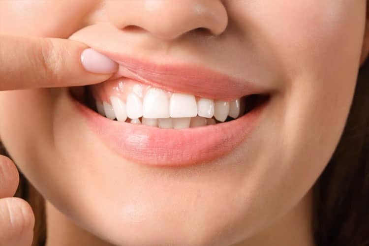 5 Tips Memutihkan Gigi Secara Aman dan Alami