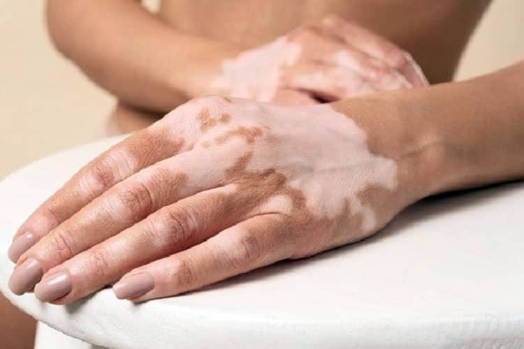 Vitiligo Bukan Kutukan, Alat Fototerapi UV RSUD Genteng Banyuwangi Bisa Jadi Solusi