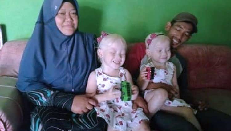 Ini Penyebab Albino, Mulai dari Mutasi Gen hingga Faktor Keturuanan