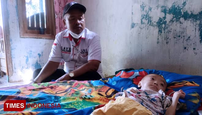 Balita Asal Indramayu Alami Penyakit Langka Sindrom Edward