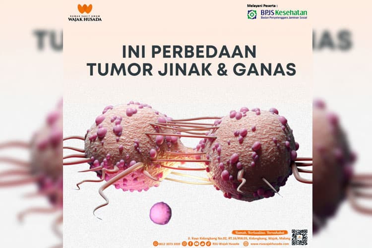 Memahami Perbedaan Tumor Jinak dan Tumor Ganas bersama RSU Wajak Husada Malang