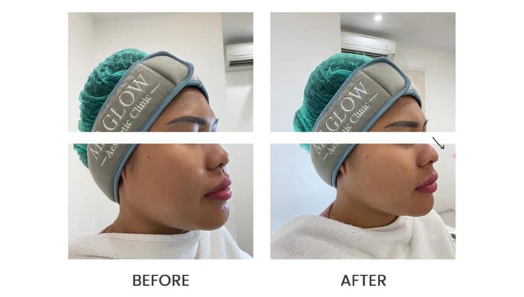 Tanam Benang Hidung, Mancungkan Hidung dengan Sempurna