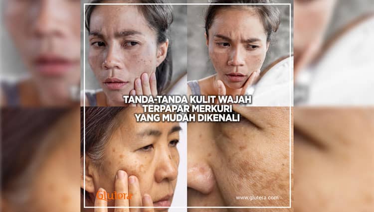5 Cara Menghilangkan Merkuri di Wajah Agar Kembali Sehat