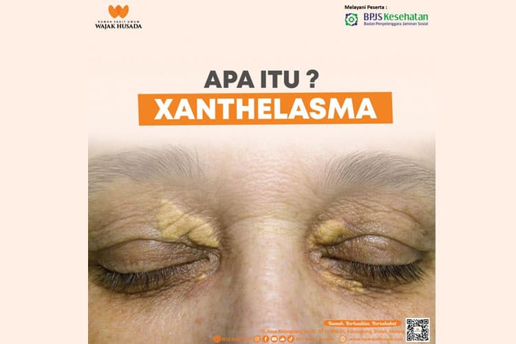 Mengenal Xanthelasma, Pengendapan Kolesterol di Kelopak Mata