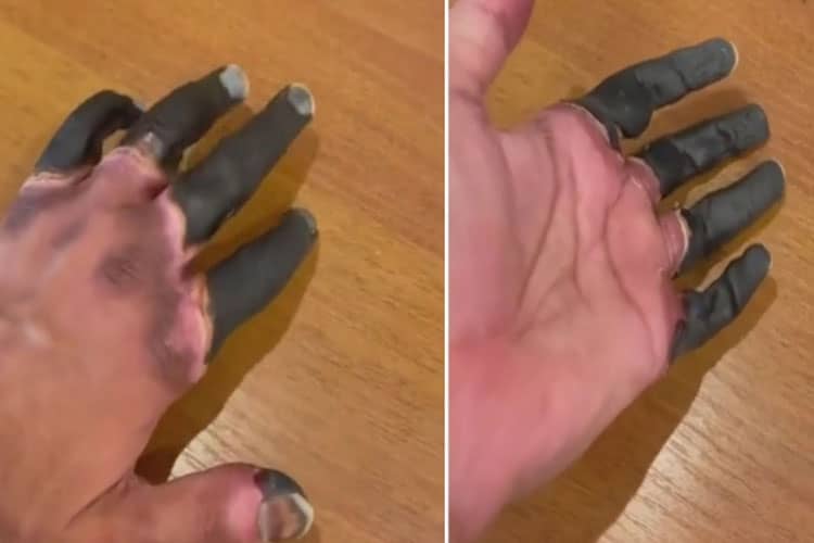 Viral di Tiktok Jari Menghitam dan Membeku, Inilah Frostbite dan Cara Menanganinya