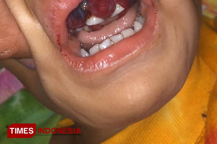 Divonis Tumor Gusi dan Infeksi Tulang, Bocah Tiga Tahun di Ternate Butuh Bantuan