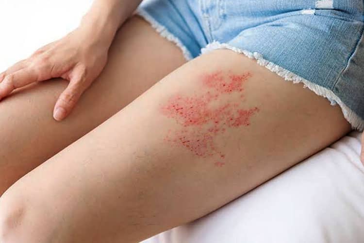 Kenapa Lansia Rentan Terkena Herpes Zoster? Ini Penjelasan Ketua Satgas Imunisasi Dewasa