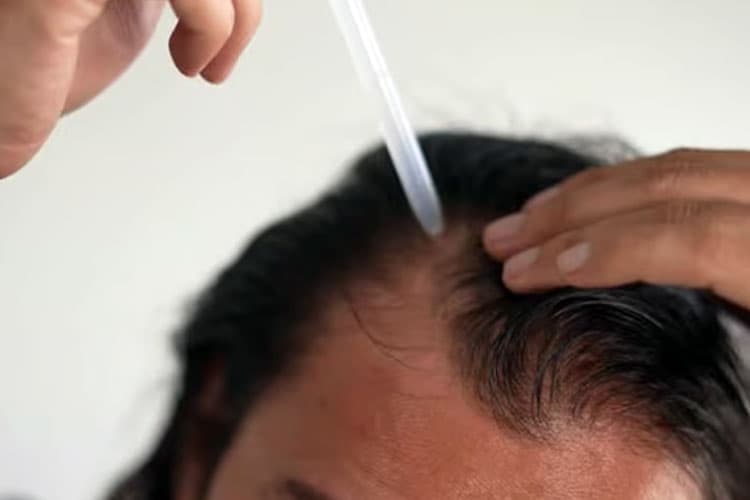 Obat Penumbuh Rambut Topikal Sebabkan Disfungsi Ereksi