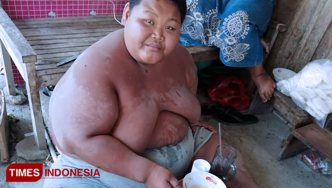 Akibat Obesitas, Berat Badan Sungadi Mencapai 150 Kilogram